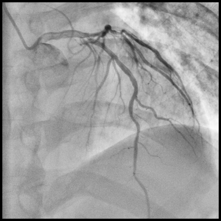 angiography machine angiography machine